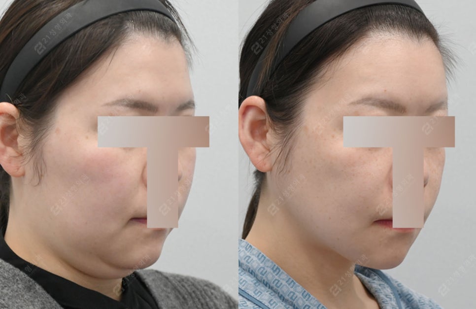 Can I Have a Clean Jawline Too? A Real Review of Double Chin Removal image 7