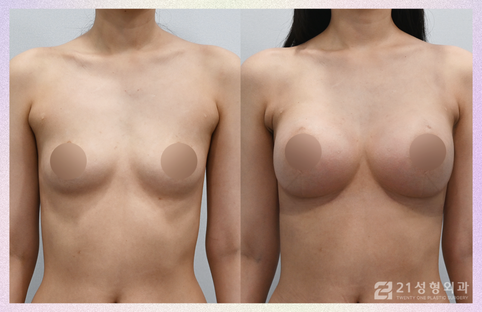 가슴성형잘하는곳 원하는 볼륨으로 확실하게 관련 이미지 1