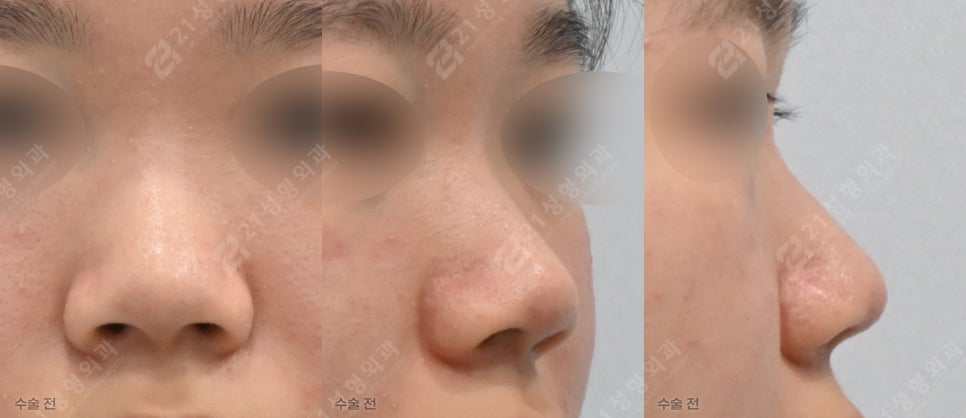 뭉툭한 코 완벽 해결? 21성형외과 원장이 밝히는 코 수술 황금 조합 관련 이미지 5