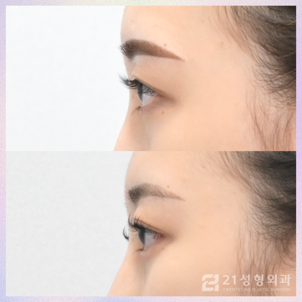눈트임성형으로 크고 선명하게 관련 이미지 5
