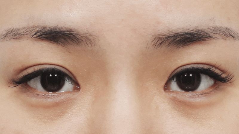 [눈 성형] 낮은 쌍꺼풀 높이기~ 관련 이미지 3