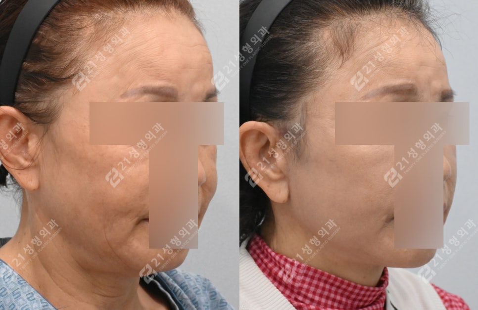 이렇게나 달라져요? 전후 차이 확실한 안면목거상 관련 이미지 1