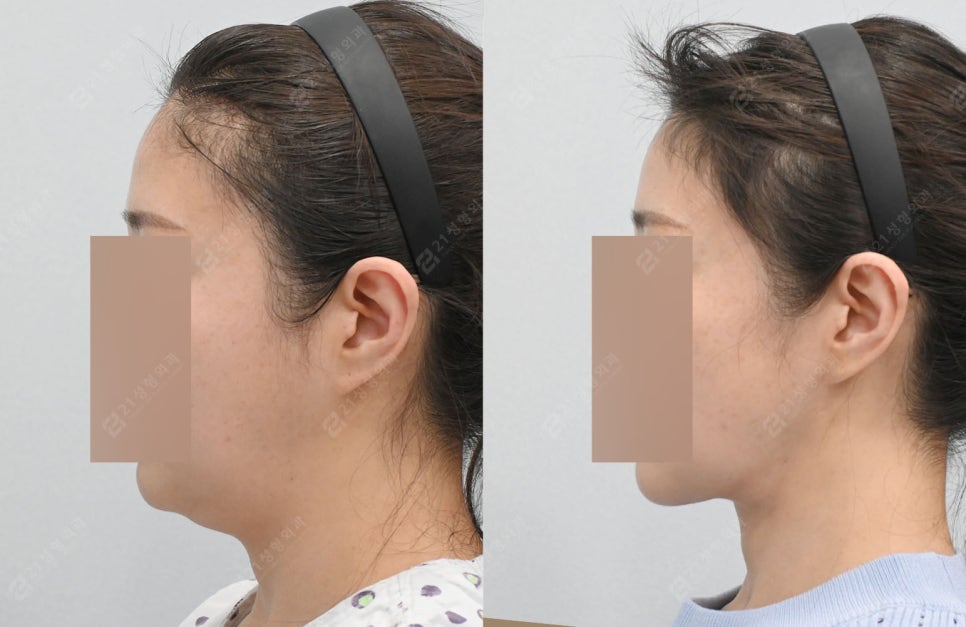 Real Review: A Smooth Improvement of Leftover Double Chin and Jowl Fat Even After Dieting image 1
