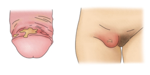 [항 바이러스제] Acyclovir(아시클로버) & Valaciclovir(발라시클로버) ③ 관련 이미지 2