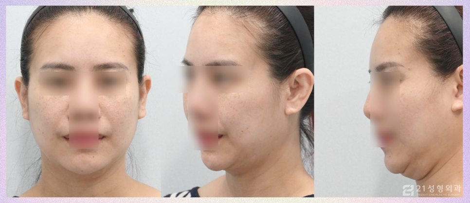 투턱지방흡입 이중턱없는 매끈한 턱 라인이 필요할 때 관련 이미지 6