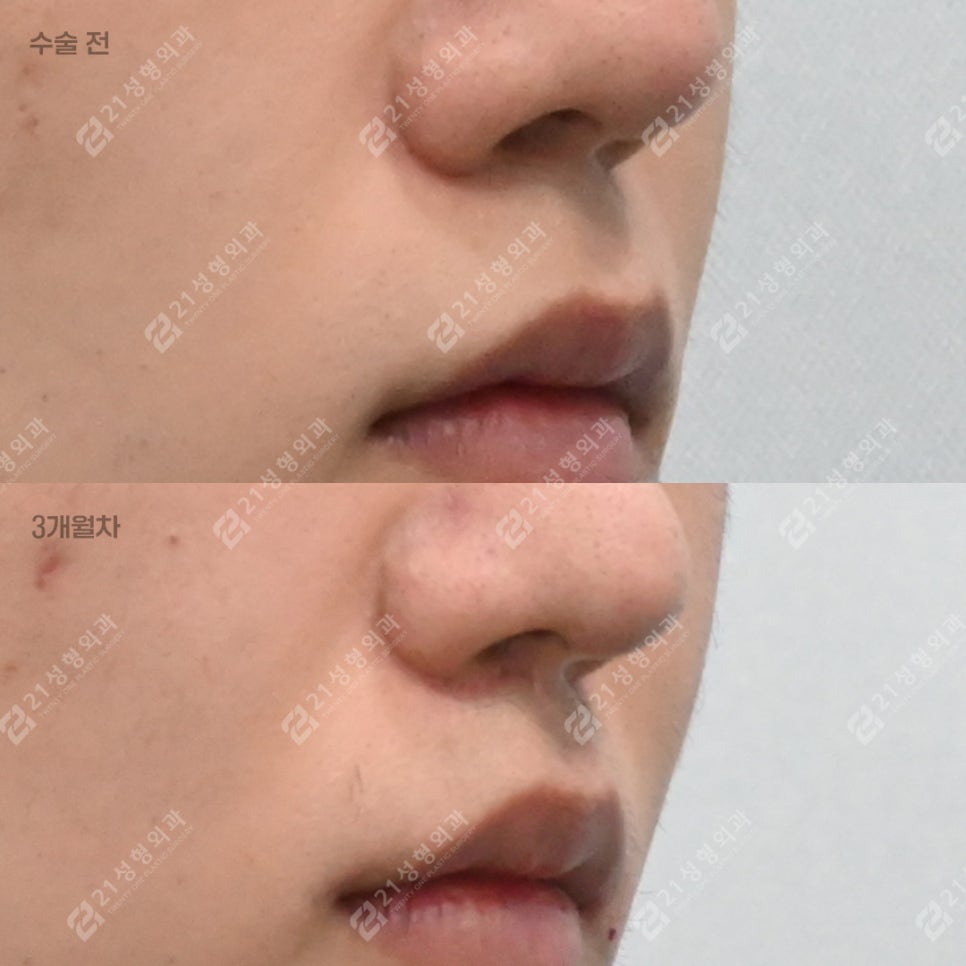 I Almost Gave Up Thinking My Long Philtrum Was Genetic—Until I Finally Looked Into 21 Plastic Surgery image 2