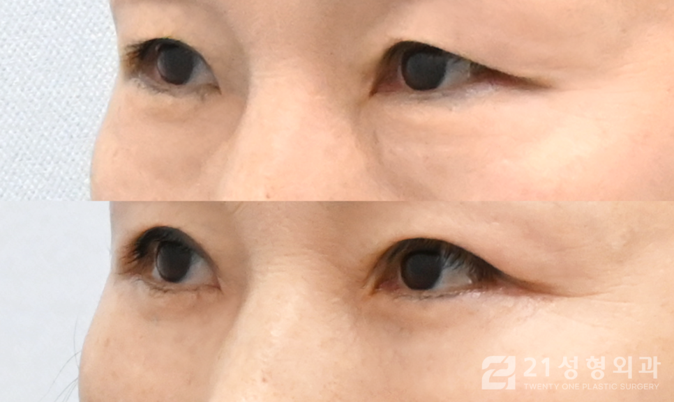 강남하안검수술 생기있는 눈매로 개선하는 방법 관련 이미지 2