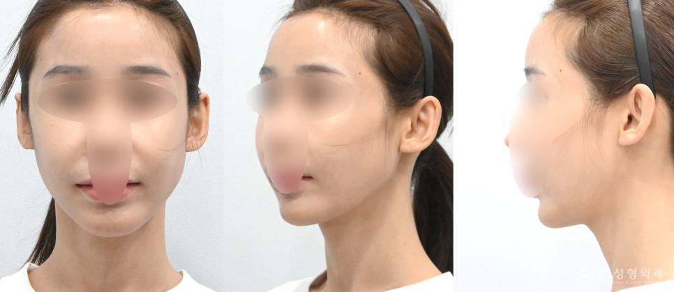 사각턱수술잘하는곳 정보를 알고 싶다면 관련 이미지 4