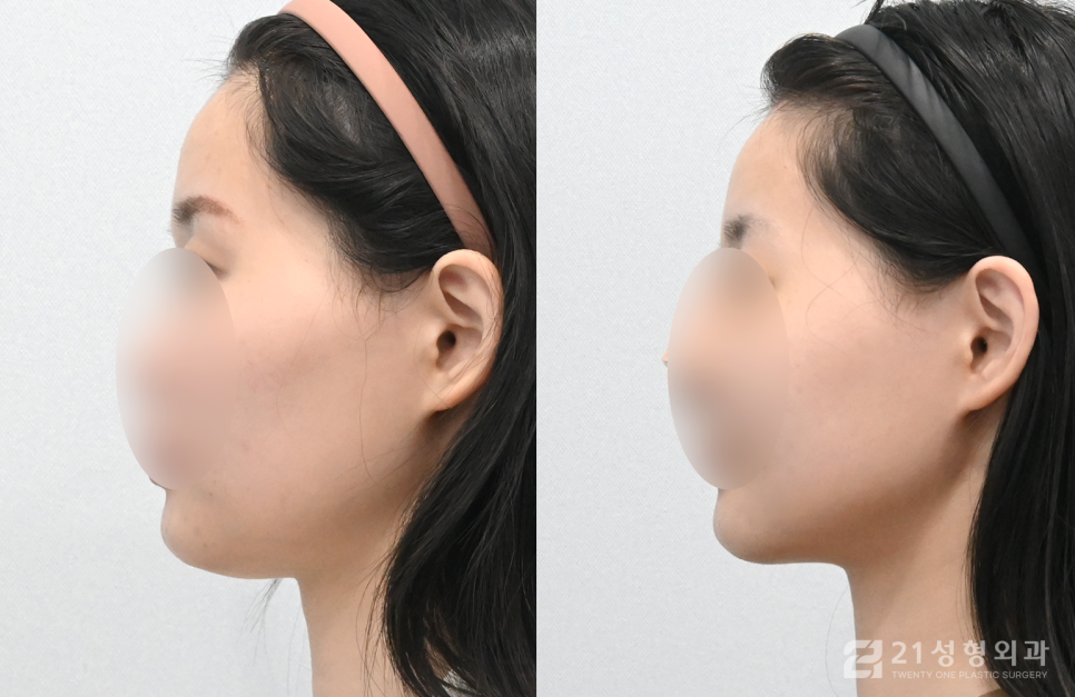 안면윤곽잘하는병원 선택할 때 중요한 점 관련 이미지 3