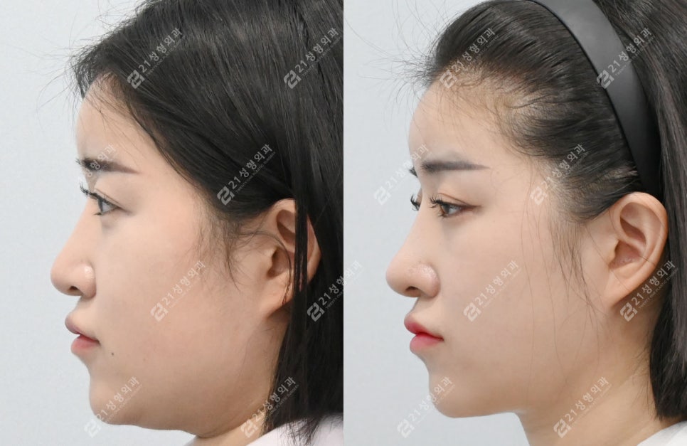 코성형 후 인상이 달라진 이유, 얼굴 중심의 차이 관련 이미지 6