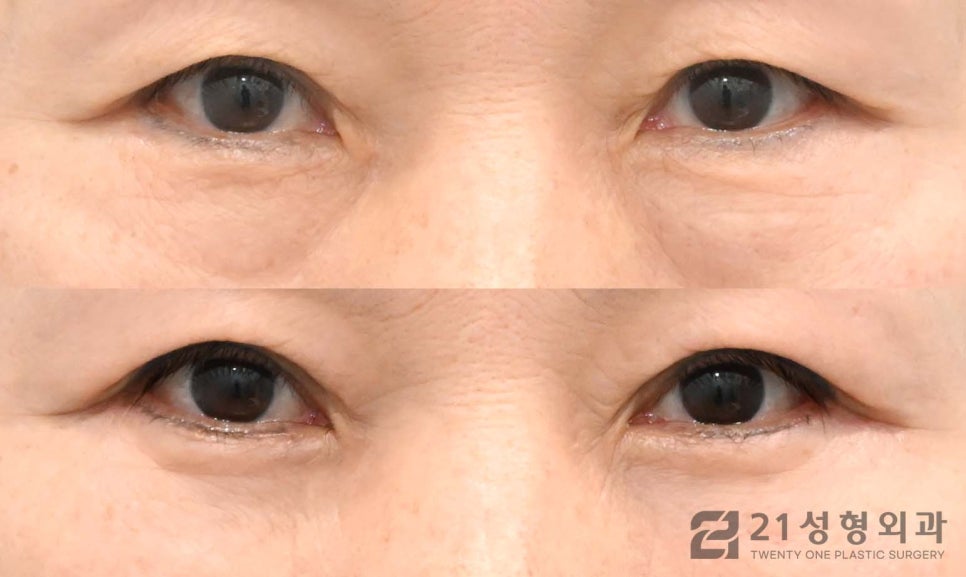 하안검수술잘하는병원 선택 노하우는 관련 이미지 1