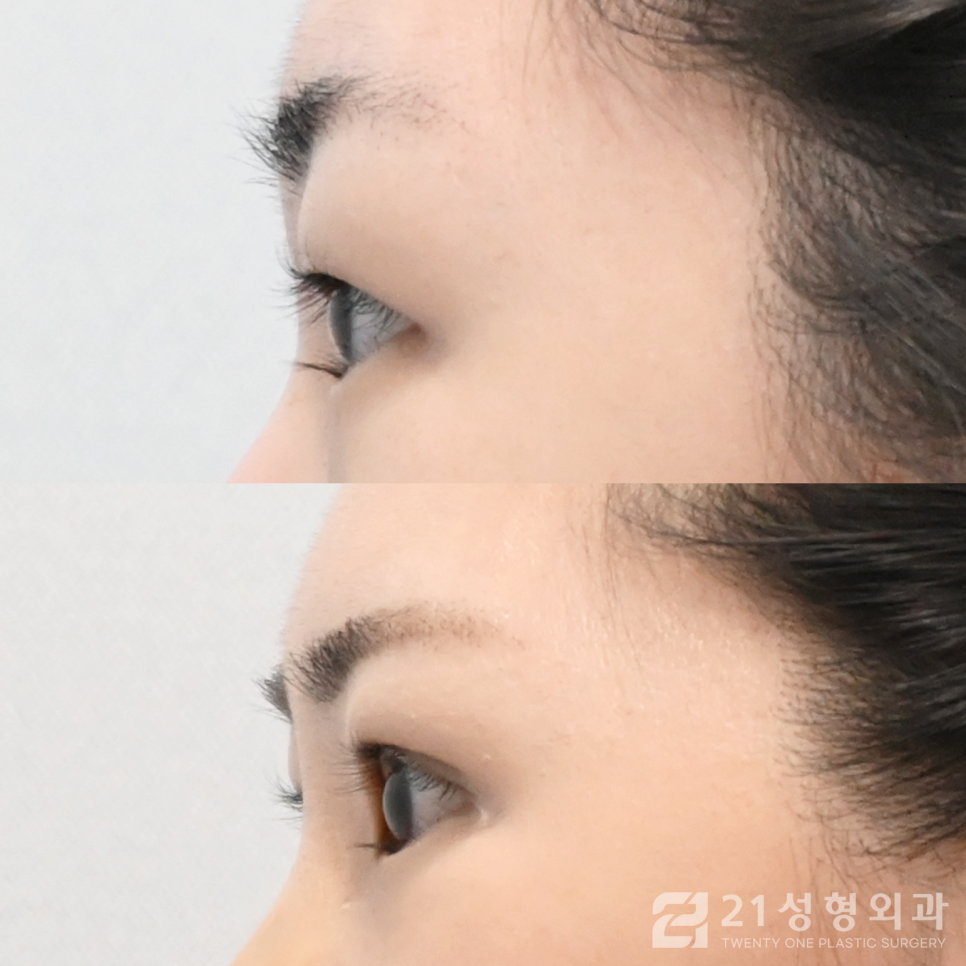 눈매교정병원 자연스러운 눈의 차이 관련 이미지 3