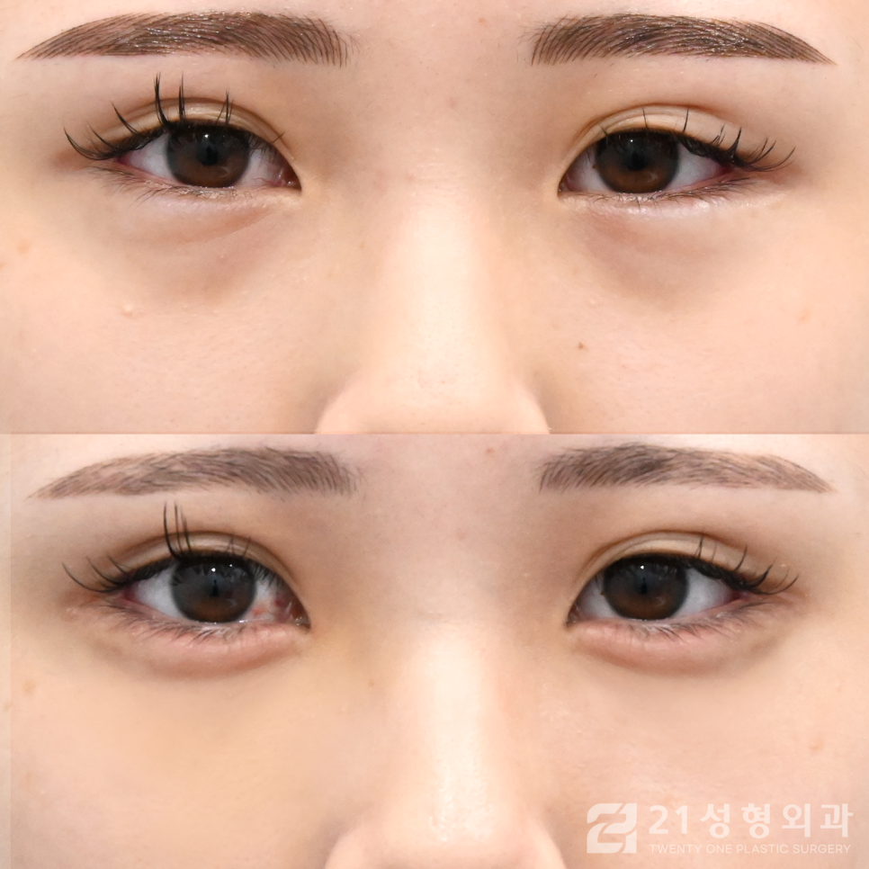 눈밑지방없애는방법 확실한 효과를 얻고 싶다면 관련 이미지 1