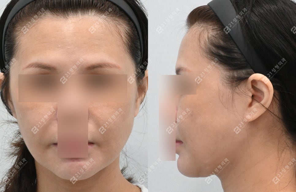 Face and Neck Lift: What Matters More Than Scars Is the Surgical Design image 3