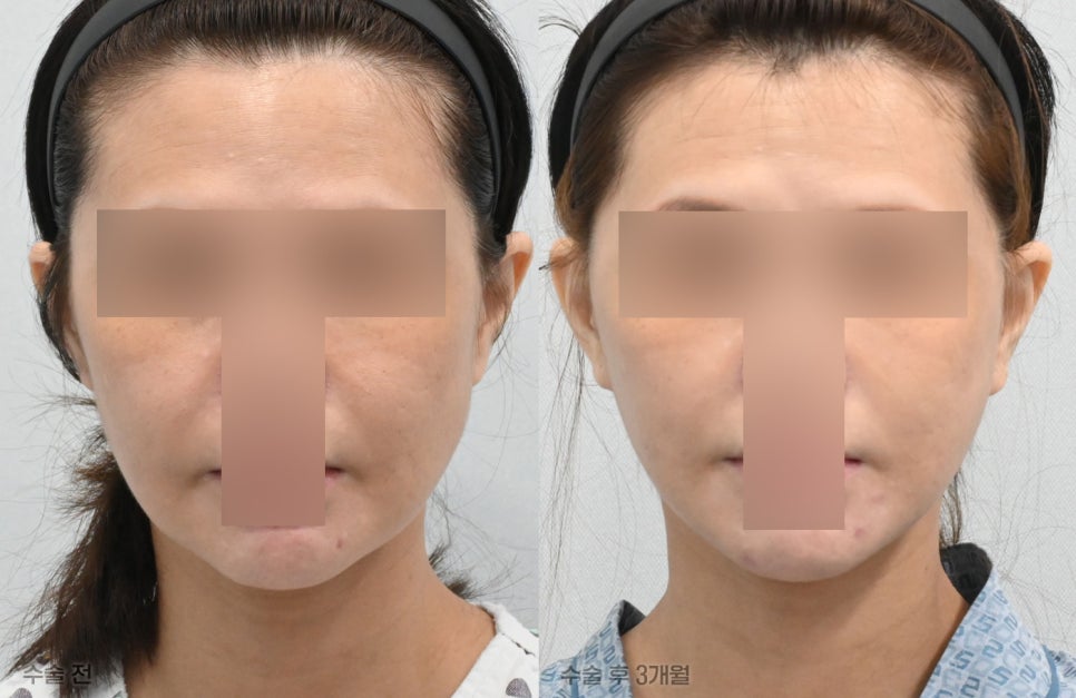 Pixie Ears After a Facelift: Why Do They Differ from Clinic to Clinic? Find Out at 21 Plastic Surgery image 1