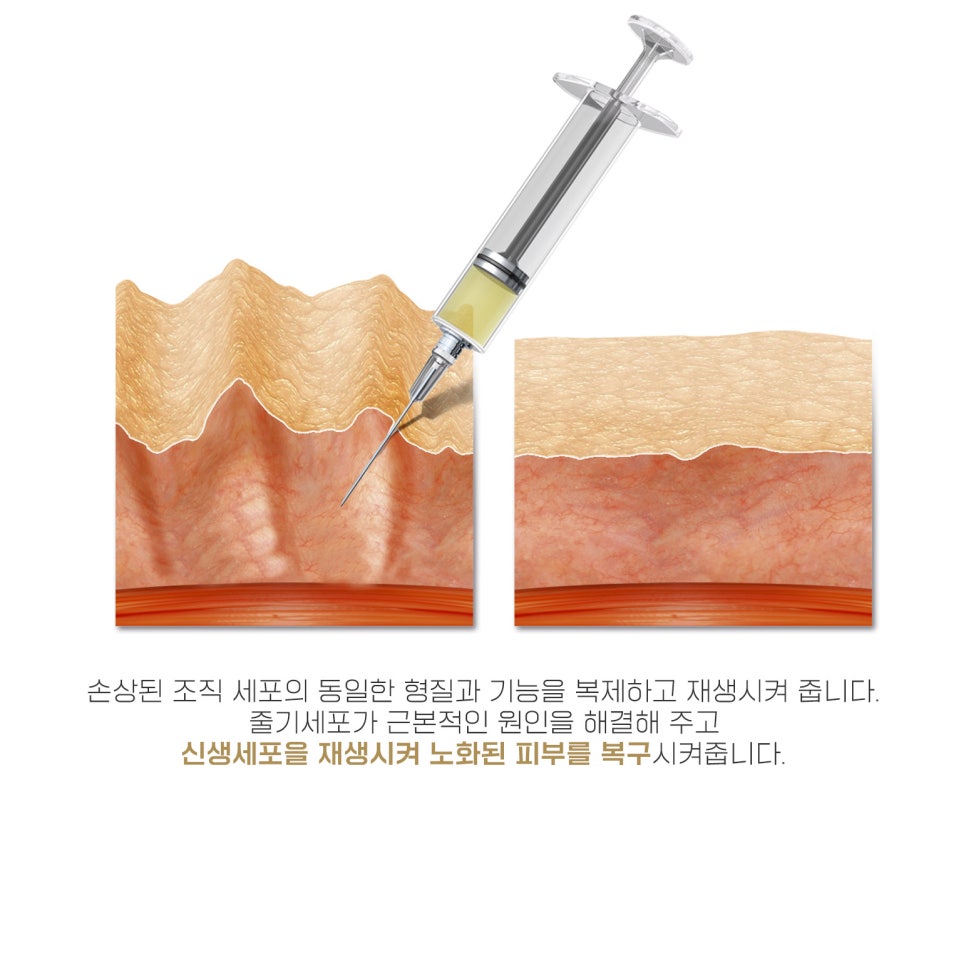 줄기세포주사로 완성하는 21살로의 젊고 탄력 있는 피부 관련 이미지 4