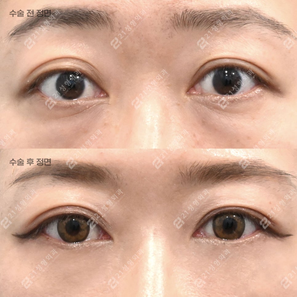 If People Always Tell You That You Look Tired, Could Under-Eye Fat Be the Cause? image 3