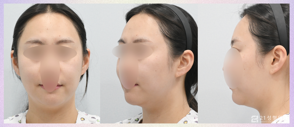 이중턱지방제거 콤플렉스라면 관련 이미지 5