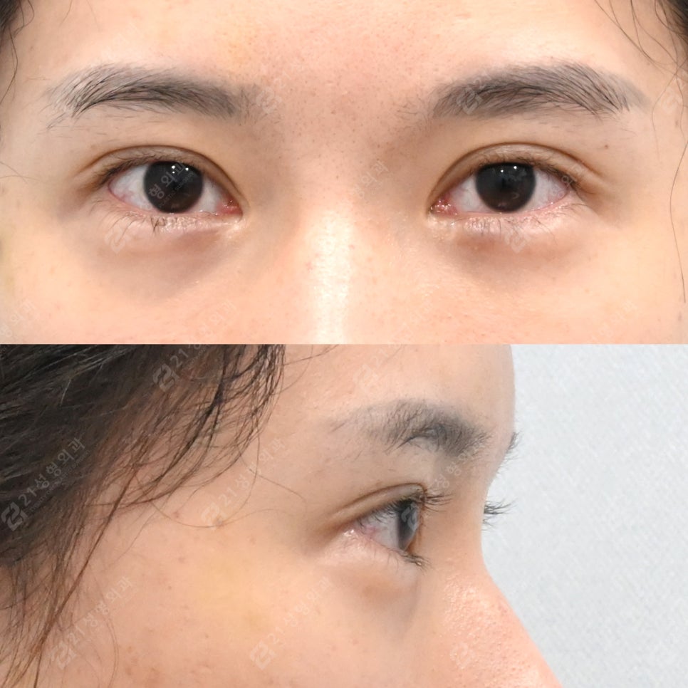 Why the under-eye area looks even more tired: your under-eye surgery may have gone wrong image 2
