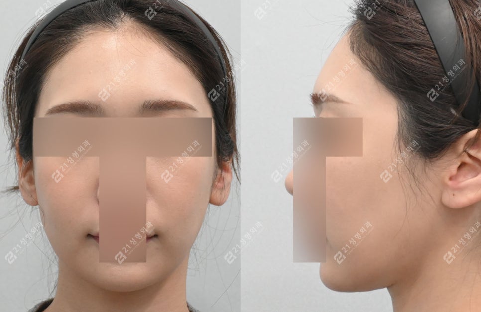 Before and After Cheekbone Reduction: Changes in Facial Width (4 Months · 1 Year) image 6