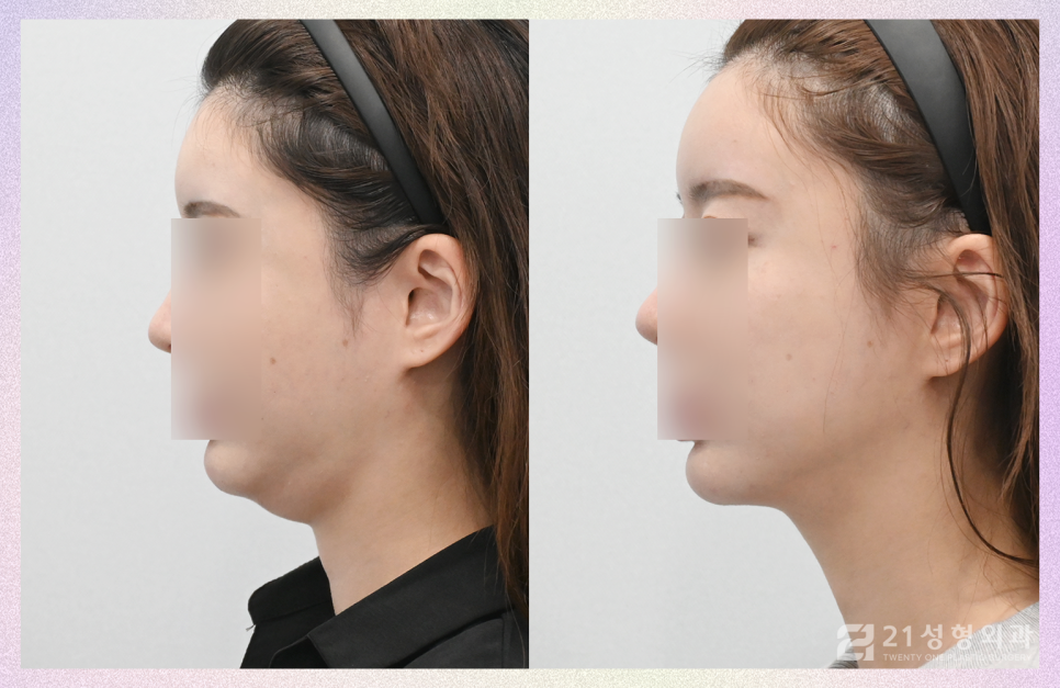 이중턱재수술은 근육묶기로 완성하자 관련 이미지 4