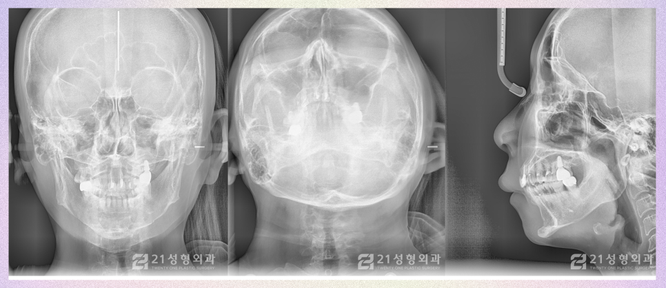 윤곽핀제거수술 제거해야 되는 기준 관련 이미지 6