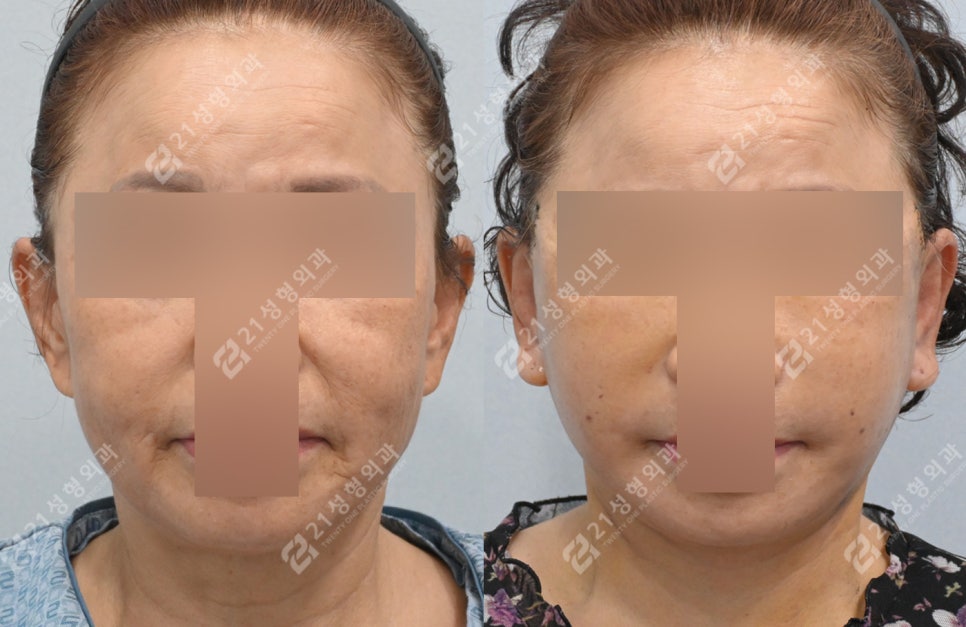 이렇게나 달라져요? 전후 차이 확실한 안면목거상 관련 이미지 4
