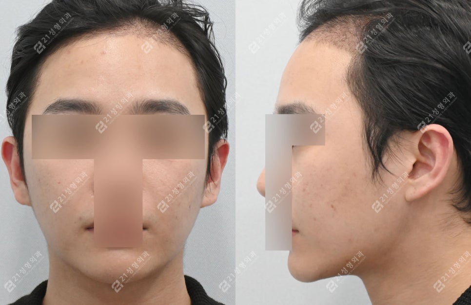 살은 안 쪘는데 왜 이중턱만 남을까? 남자 이중턱의 진짜 원인 관련 이미지 3