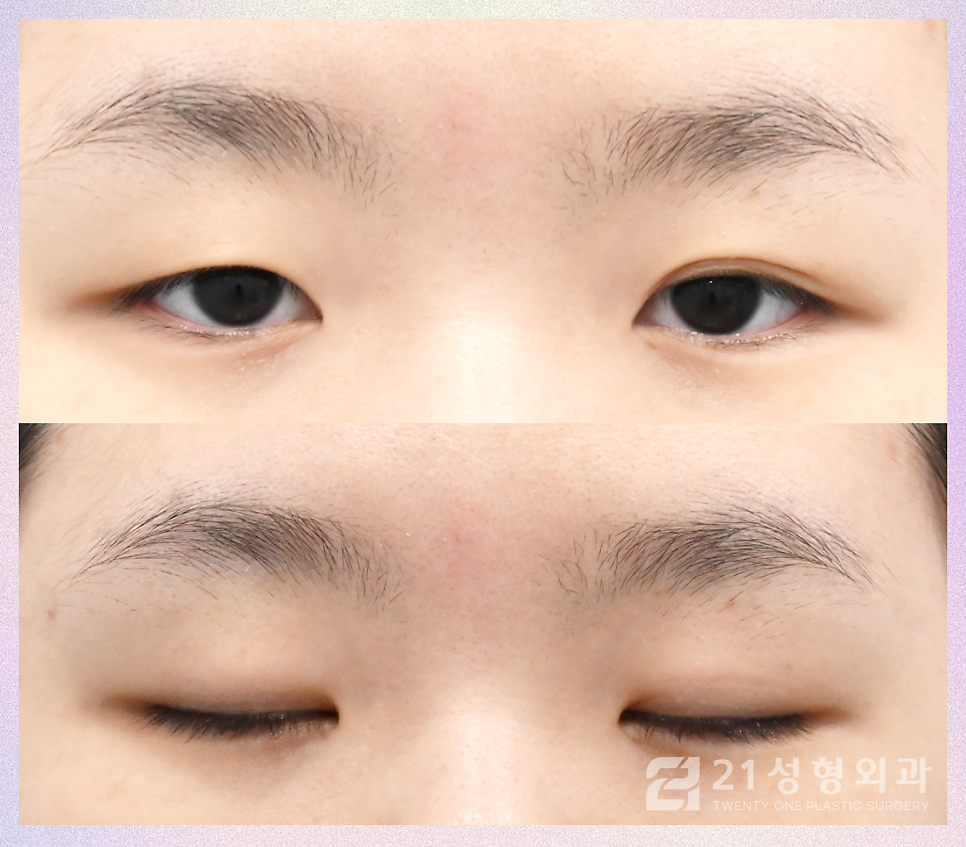 강남쌍꺼풀수술잘하는곳 찾아보는 포인트 관련 이미지 5