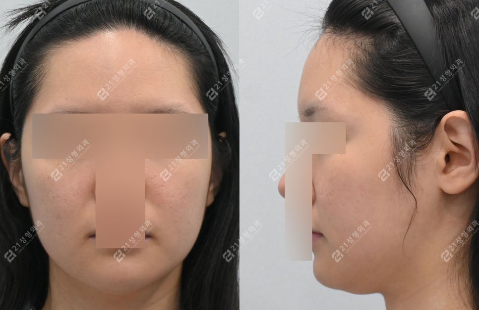 Double Chin Surgery, There Was Actually Another Cause (Real Case Analysis) image 2