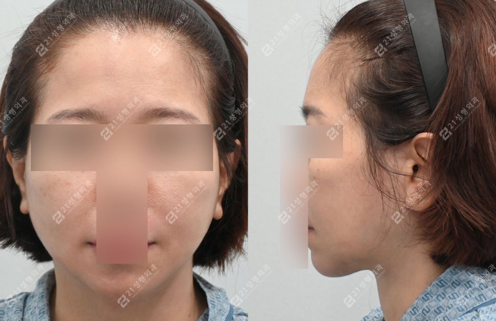 거상 수술의 효과를 극대화하는 방법, 안면목거상 + 근육묶기 케이스 관련 이미지 5