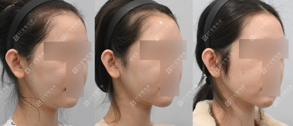 이중턱 수술 후 턱밑 피부가 접혔는데 이게 정상이라고요? 관련 이미지 6