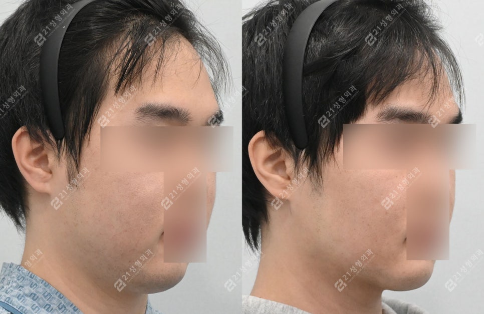 Male Double Chin + Chin Advancement Surgery Real Case: Why the Mood and Impression Change image 7