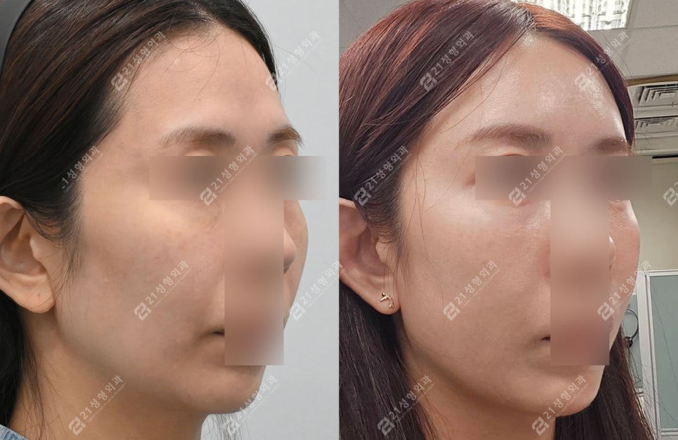 Could a lump you feel after fat grafting be cancer? image 7