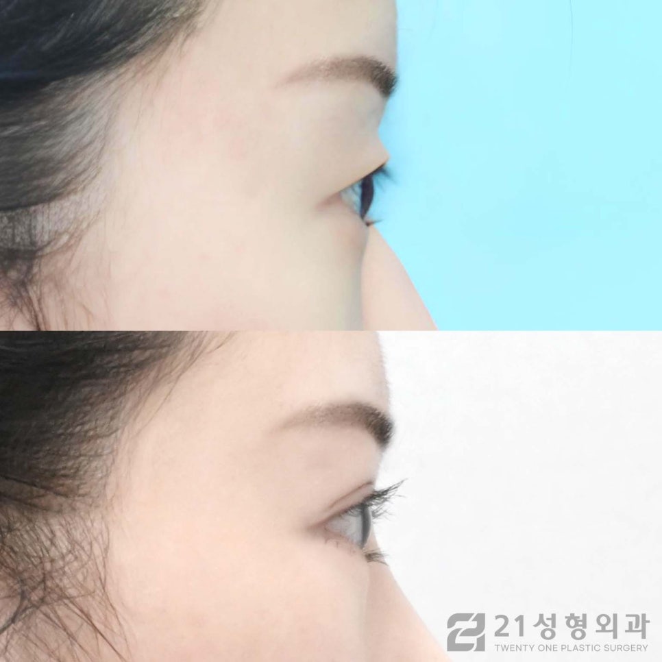 절개쌍수 특징적인 점에 대하여 관련 이미지 3