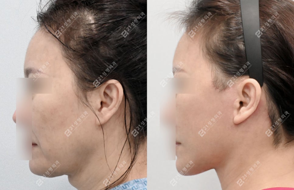A Face That Needed a Lift, Not a Thread Lift — and There Was a Reason image 7