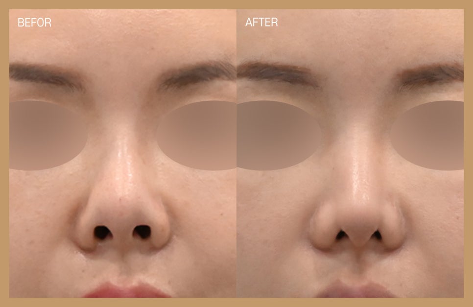 반버선코수술 쉽게 알아보는 방법 관련 이미지 1