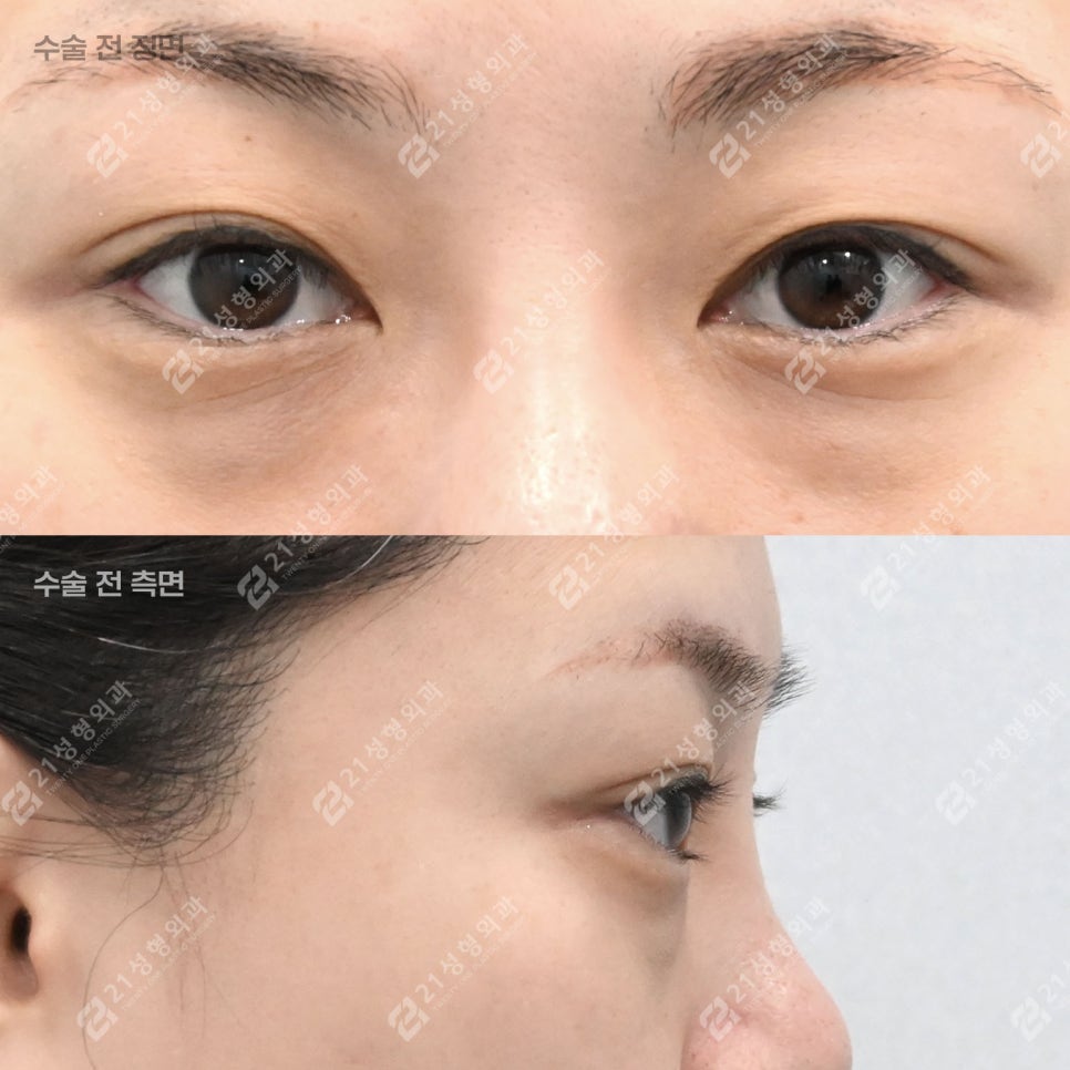 Can Tired Eyes Be Changed? A Real Review of Under-Eye Fat Repositioning for a Woman in Her Late 30s! image 2