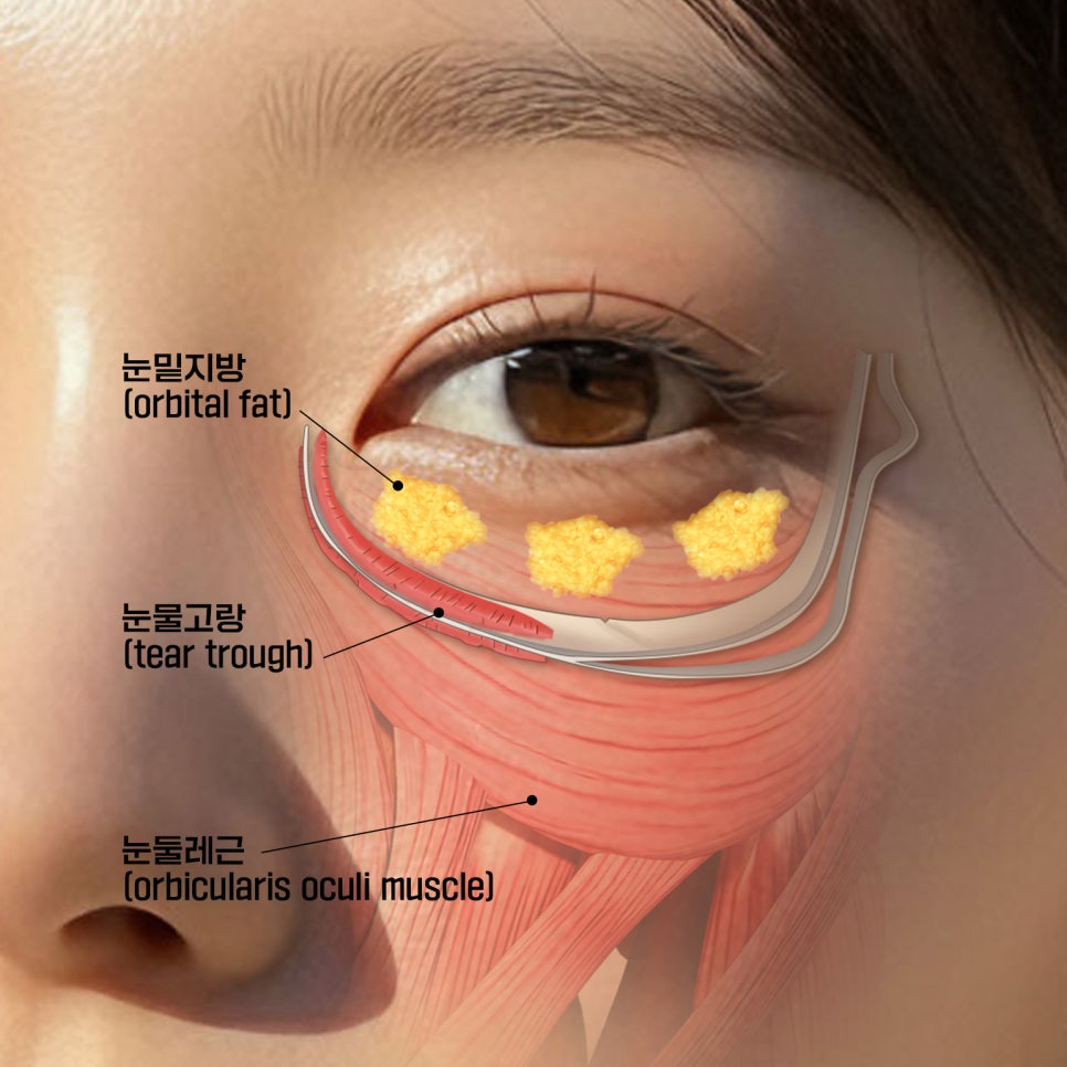 똑같은 눈밑수술도 결과가 다른 이유 관련 이미지 2