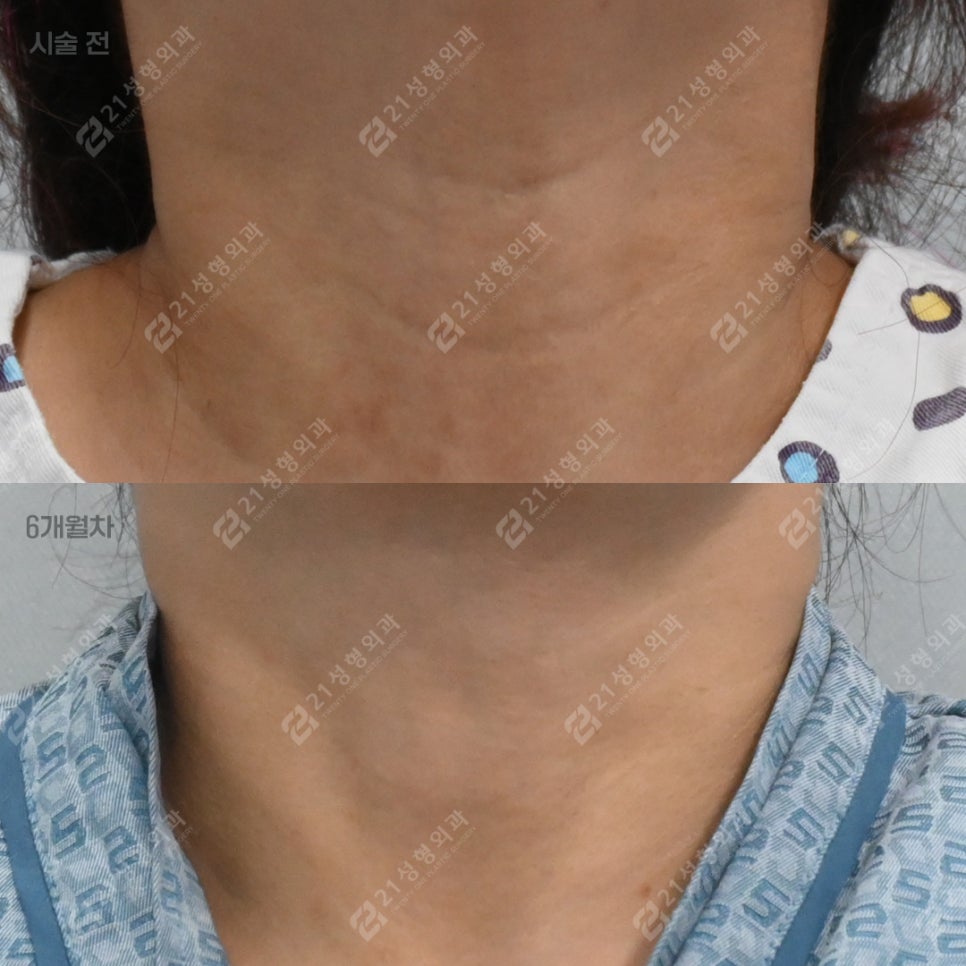 That Posture You Use While Looking at Your Smartphone—Half of Your Neck Wrinkles Start There. — 21 Plastic Surgery Neck Wrinkle Treatment image 7