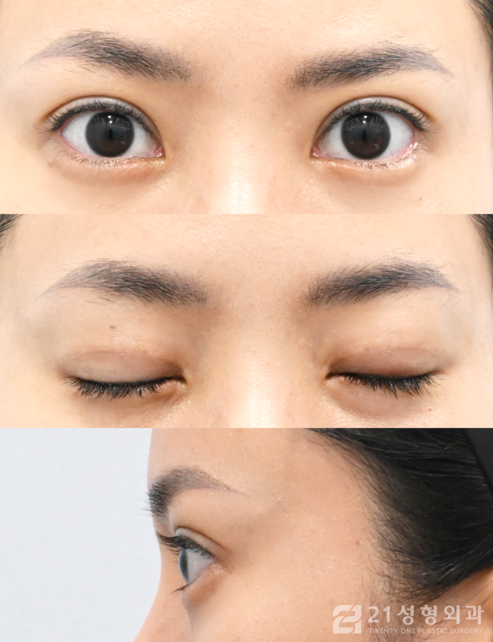 강남역눈매교정 이미지 개선을 원한다면 관련 이미지 5