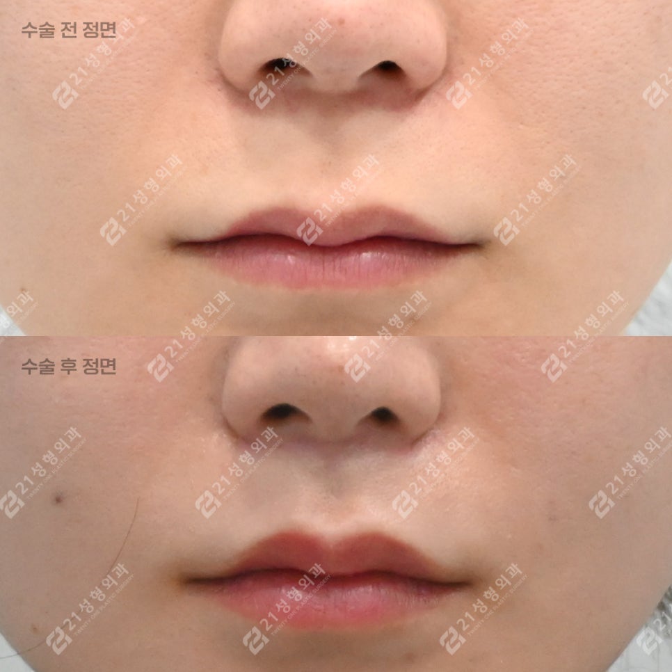 What to Check If Your Philtrum Looks Long image 1