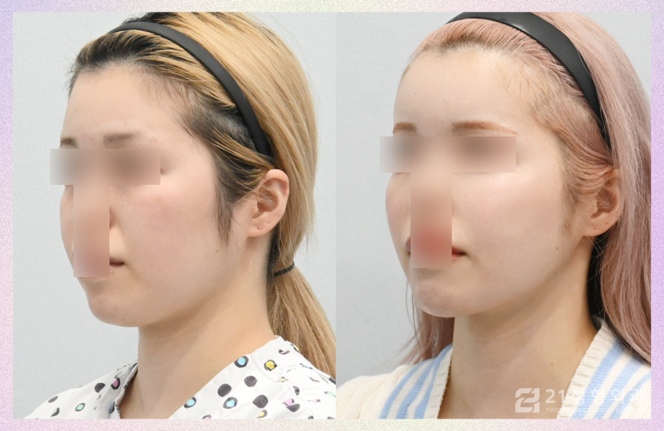 얼굴지방이식잘하는곳 노하우가 궁금하다면 관련 이미지 2