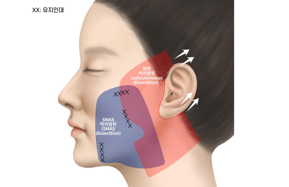 Facelift Surgery Without a Pulled Earlobe: A Real Patient Review image 3