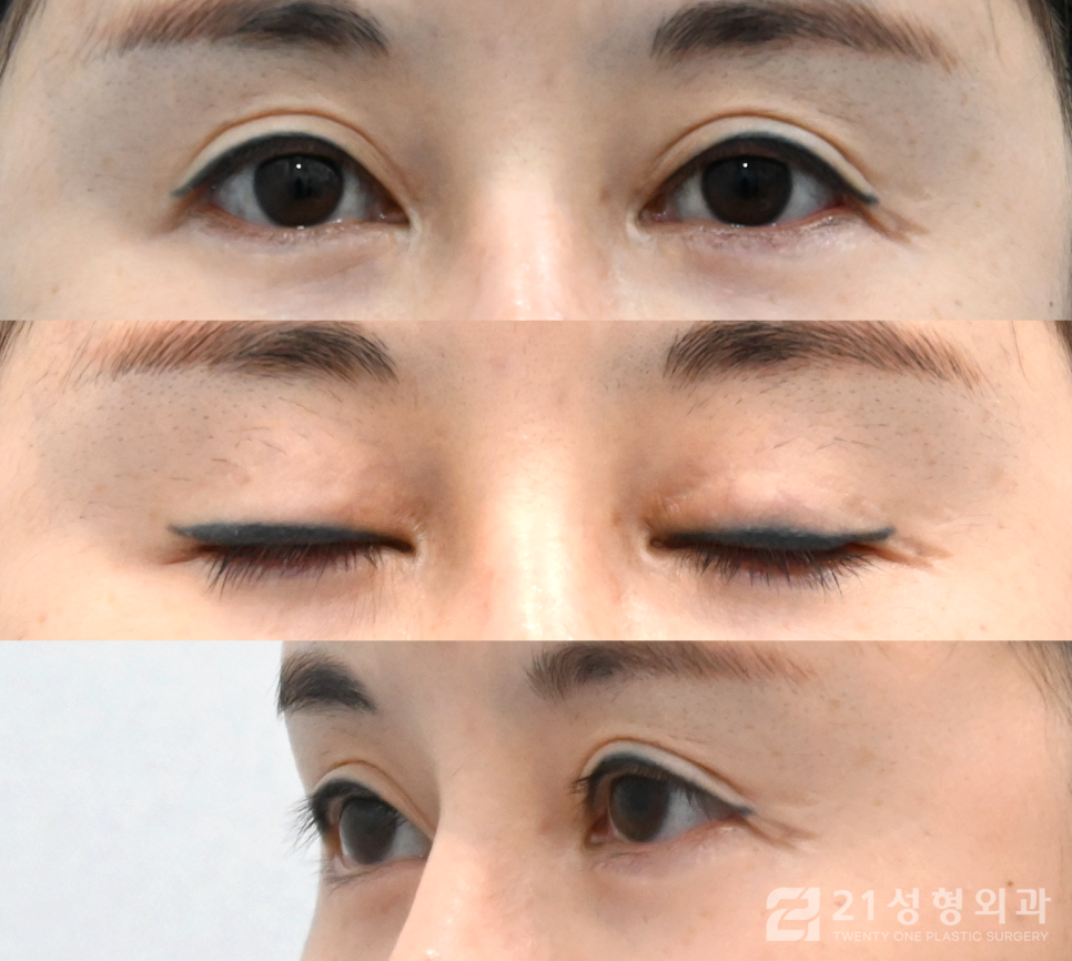 앞트임복원성형외과 잘하는 곳의 특징 관련 이미지 4
