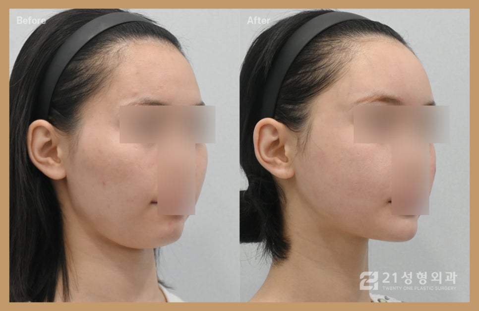 부작용 없는 안면윤곽성형외과 고르는 꿀팁용 관련 이미지 2