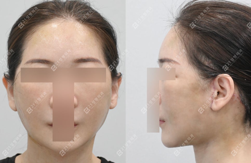 Natural Ear Lines Without Knife-Edge Earlobes: Facelift + Neck Lift Surgery Review image 5
