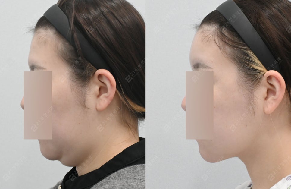 Can I Have a Clean Jawline Too? A Real Review of Double Chin Removal image 1