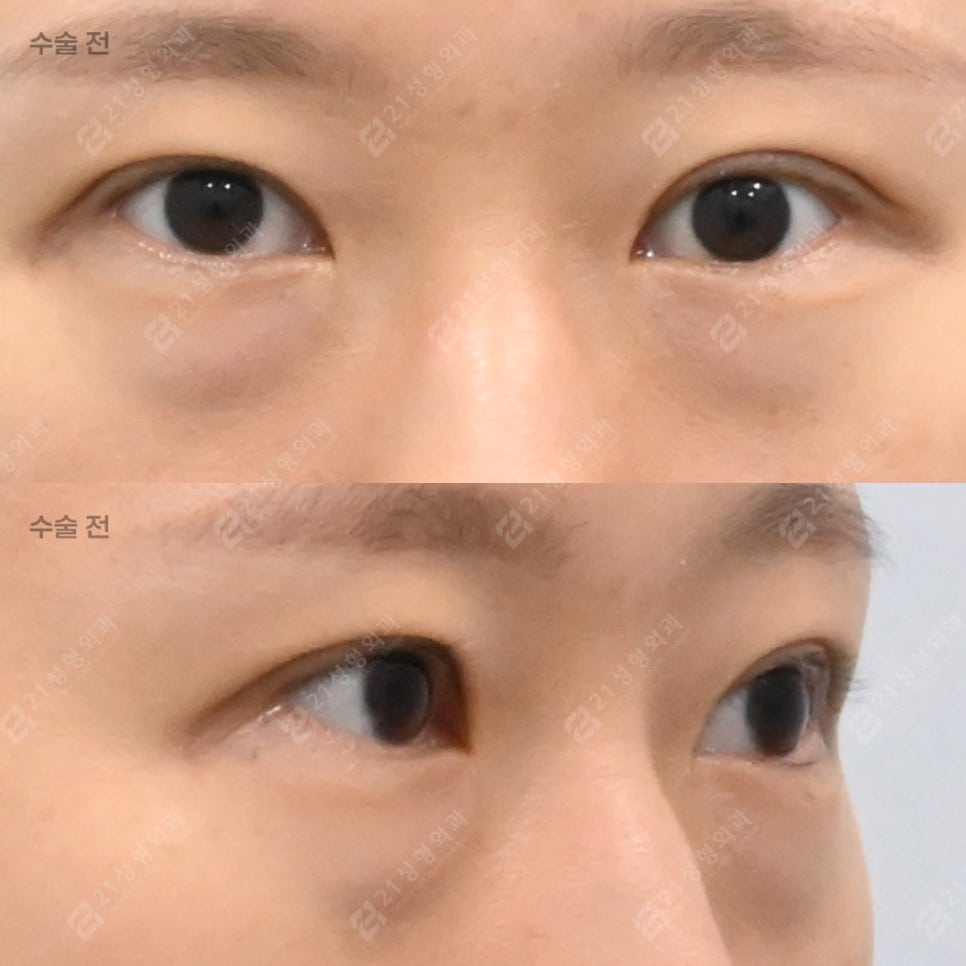With Lower-Eyelid Fat Repositioning and Fat Grafting: The Real Reason Your Eyes Look Different image 5