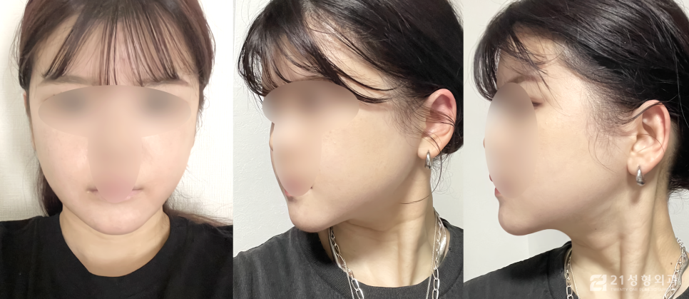 안면윤곽 3종 케이스에 따라 다른 수술과정 관련 이미지 4
